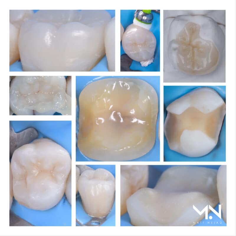 Indirect Restorations with the Biomimetic Approach