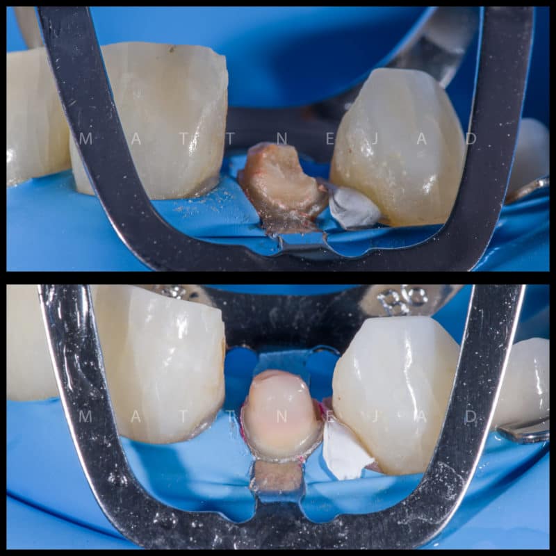 Restoring Endodontically Treated Teeth with the Biomimetic Approach: Strategies, Concepts and Techniques.