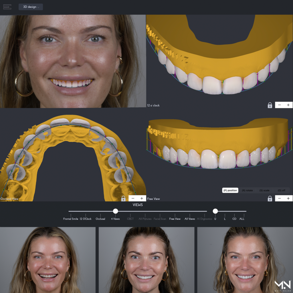Integrating Digital and Analog Techniques in Smile Design and Treatment
